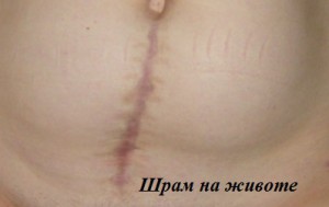 шрам после операции
